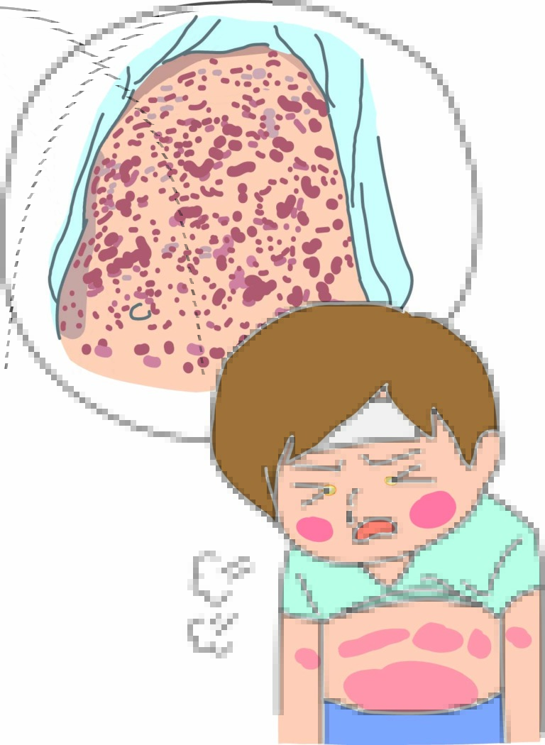 麻疹(はしか)が流行しています。今後も流行が続くかもしれません。ご注意を。